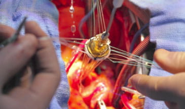 Valvular Heart Disease for the Clinician | Pri-Med